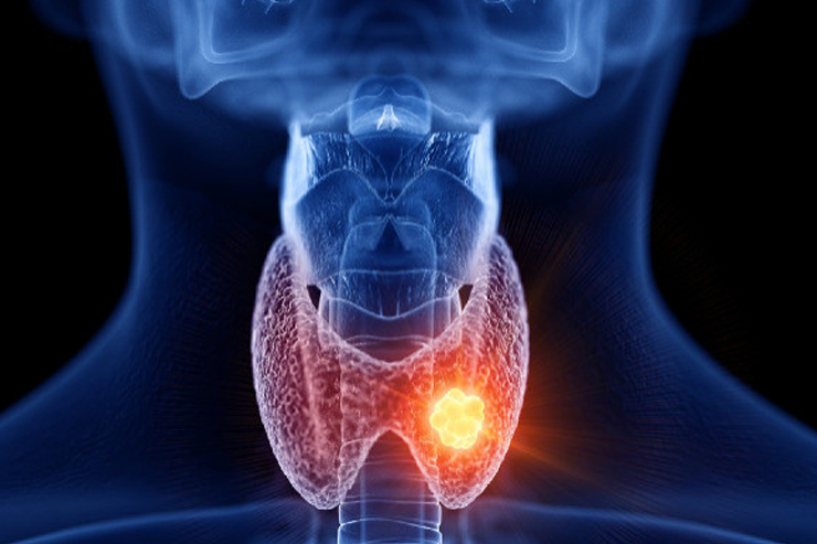 Thyroid Management