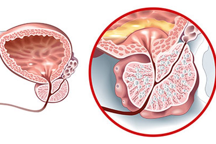 Erectile Dysfunction & Prostate Management