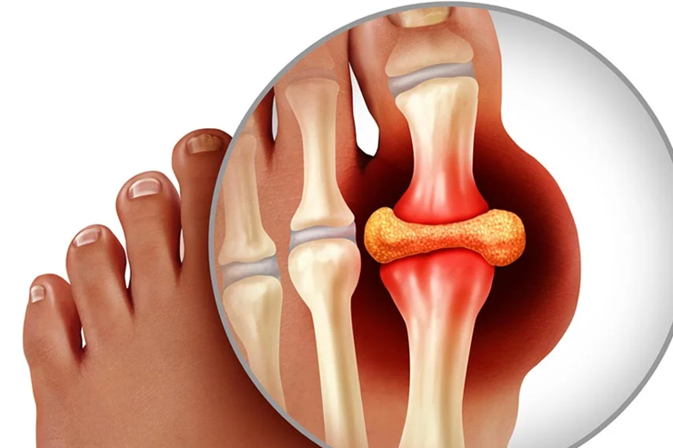 Gout & Arthritis